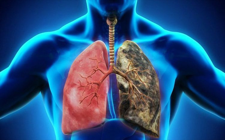 Tỷ lệ mắc móng chân dùi trống ở bệnh nhân ung thư phổi