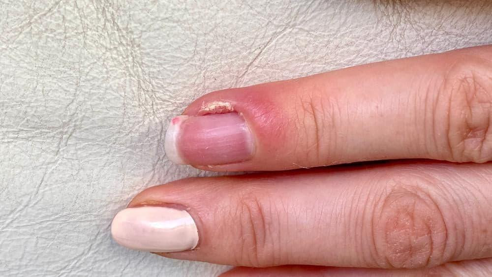 Vấn đề về móng tay: Xước măng rô
