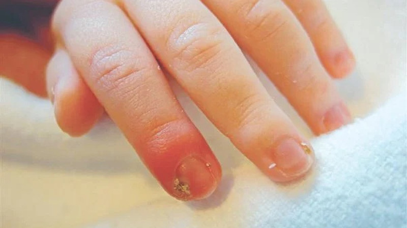 Vệ sinh tay sạch sẽ hàng ngày để phòng ngừa nhức khoé móng tay