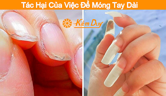 Vi khuẩn tích tụ dưới móng tay dài gây hại sức khỏe