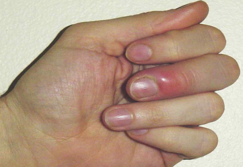 Vùng móng tay bị viêm nhiễm có mủ sưng đỏ