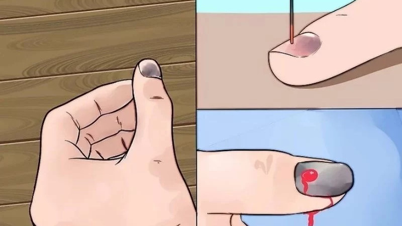 Xử lý móng tay bị phồng rộp và bầm tím đúng cách là một phần quan trọng trong cách dưỡng móng tay bị hư tổn.